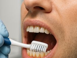 Quella dentaria è dannosa alle gengive: la placca dentale, cos’è e come si forma
